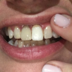 Temporary Crown Care Tips - Victoria Village Dentistry