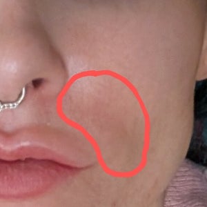 Smile line filler issues, long-term (photo)