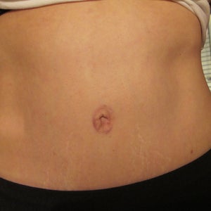 Umbilicoplasty to Reduce Large Belly Button After Tummy Tuck?