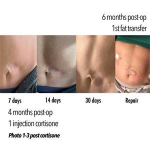 lipo c injection before and after 1 month Lipotropic Injections main image 1