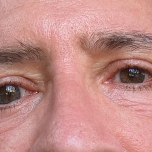 What can I do to correct wrinkles in the under eyes after I heal