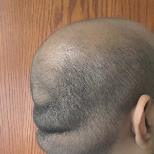 What causes rolls on the back of the head and how do I get rid of