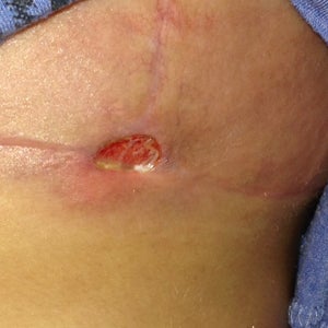 Surgical incisions for reduction mammoplasty. (a) An incision is