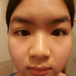 Double eyelid sales disappear