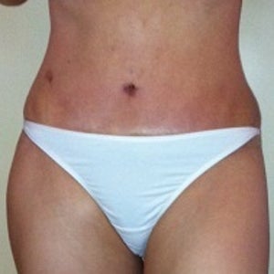 Burning Stabbing Pain in Pubic Area with Lumps After TT and Lipo