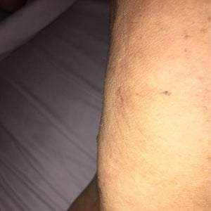 Love my TT hate my inner thigh Lipo. Why are my inner thighs wicked hard  and crepey? (Photos)