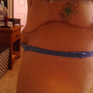 Is it normal for my pubic area below my scar to stick out more then my  belly?
