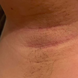 Really deep creases wrinkles under armpit can they be removed