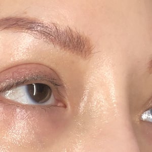 double eyelid surgery review