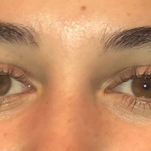 wrinkles around eyes in 20s