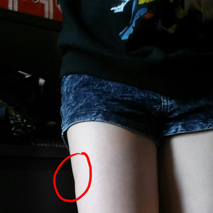 What Can I Do To Fix The Dent In My Right Thigh Photo