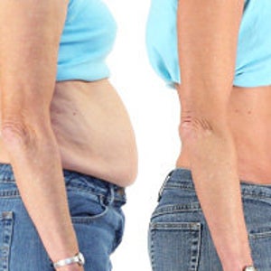 Can the Tummy Tuck Belt Really Work?