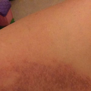 chemical peel for stretch marks near me