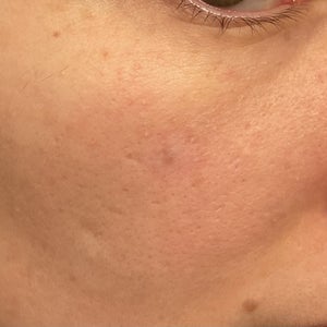 topical glutathione reddit Will a retinoid cream help minimize the appearance of my mole removal scar?  (photos)