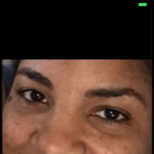 permanent solution for under eye hollows