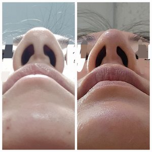 Rhinoplasty revision and scar. What can I do to improve this? (Photo)