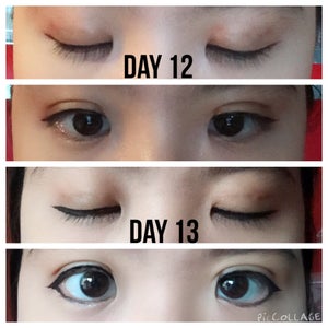 double eyelid surgery recovery pictures