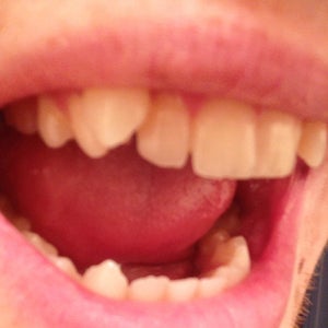 How Long Will It Take To Correct My Vampire Teeth Photo