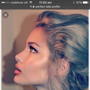 Can I create a button nose using dermal filler? (Photos)