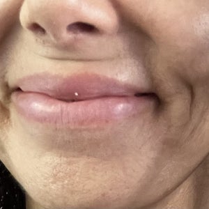 2 Line Filler – So Far Lost Second smile line - how do you get rid of this? (Photo)