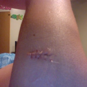 My Dissolvable Stitches Are Coming Apart But I Only Had The Procedure Done 4 Days Ago Normal Photo