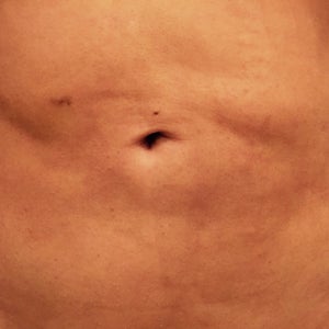 Will my mons pubis improve? Should I get it liposuctioned again? Any other  treatment to improve my results? (Photo)