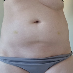 Currently on Ozempic for weight loss, should I expect loose skin and will I  require a tummy tuck? (photos)