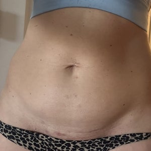 lipo bad results on c section scar Fat remains in abdomen 1 year post-op. Is this a poor abdominal liposuction  outcome? (photos)