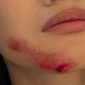 Options for new scar on face? Help (Photo)
