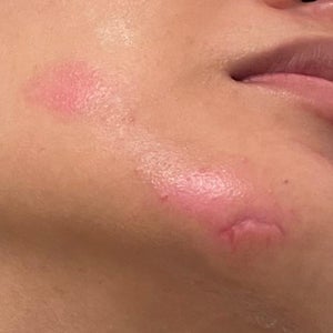 Options for new scar on face? Help (Photo)