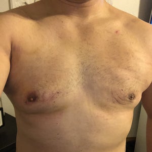 Why Am I Noticing Asymmetrical Healing Swelling 2 Weeks Post Gynecomastia Surgery Photo