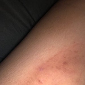 Dark patches/scars on inner thigh, is there anyone who knows where