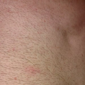 Laser hair removal boils folliculitis Photos