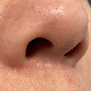 Options for improving scar line (Photo)