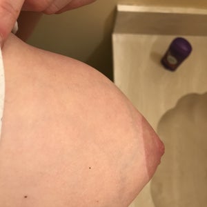 Why do my breast look like torpedos still 8 months post op? Had breast lift  with augmentation. (photos)