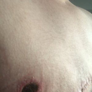 Did my nipple fall off? (Photos)