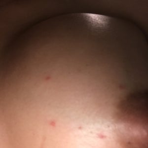 Rash on boobs after breast augmentation. Should I be concerned? (Photo)