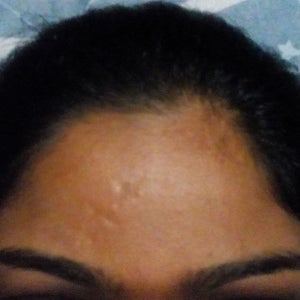 I've had stitch marks on my forehead for 17 years. How can I get rid of  these and get a clear face? (Photo)