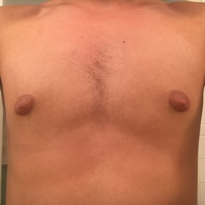 I have puffy nipples, since I was like 11 or 12, but as far as I can see it  is not gynecomastia. (photos)