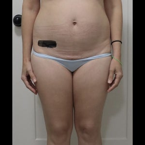 Can I have a lipo 360 instead of a tummy tuck? (Photo) Can I have a lipo 360 instead of a tummy tuck? (Photo)