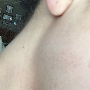 Why is the hair on my neck face growing back worse after several