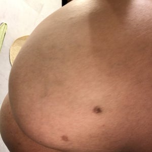 How do I get rid of incision marks 2 years post BBL? (photo)