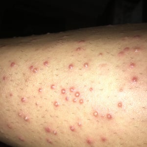 I developed folliculitis after first laser hair removal session