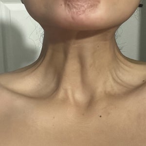 Tightness, muffled hearing & choking sensations complications after buccal  fat & chin lipo (Photos)