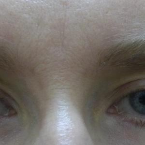 how to fix eyelid fold