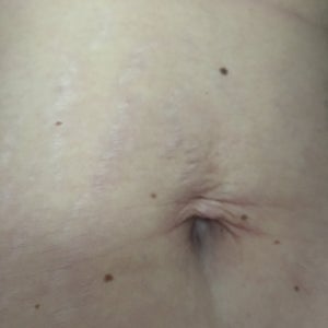 Belly button piercing deals with stretch marks