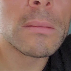 Juvederm and hyaluronidase on overfilled nasolabial folds Juvederm and hyaluronidase on overfilled nasolabial folds