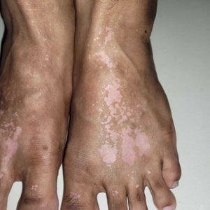 flawless beauty and skin glutathione White patches due to hydroquinone use. How much time will this take to  resolve? (Photo)