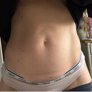 lipo during c section Liposuction during C-Section: This Is Everything You Need to Know main image 1