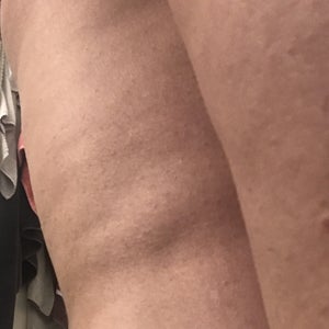 Inner Leg Dent Slope After Liposuction How Can This Be Fixed Photos